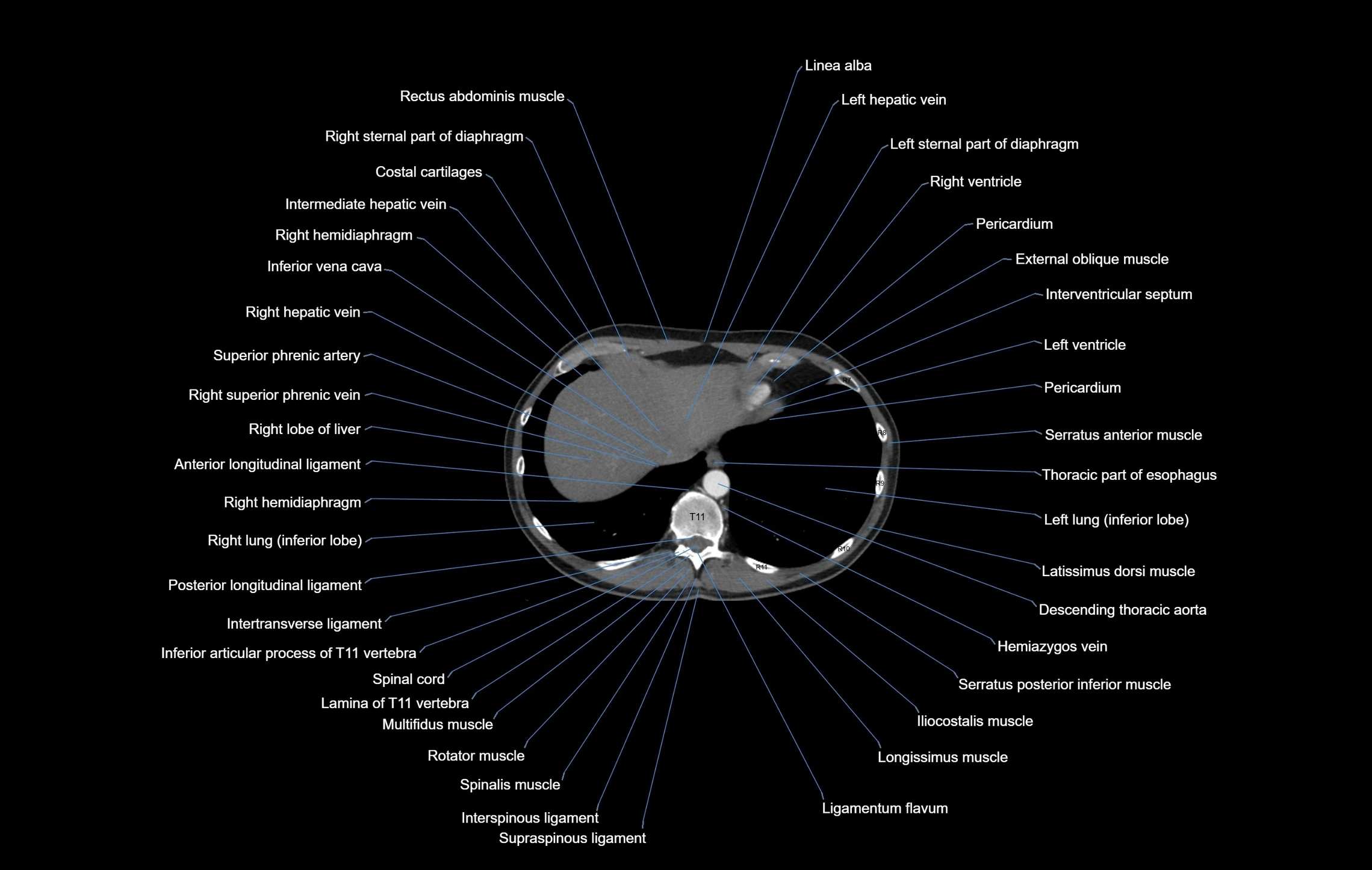CT chest (thorax) soft tissue window labelled axial cross sectional anatomy radiology image-00102.webp